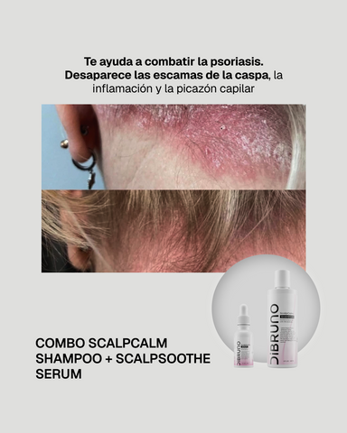 Combo ScalpCalm Shampoo+ ScalpSoothe Serum